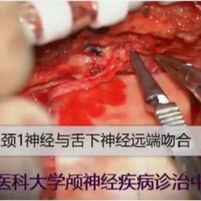 徕卡神刀博览第108期|专访中国医大一院李志鹏：显微镜下面神经重建术 治疗面瘫疗效不断提升