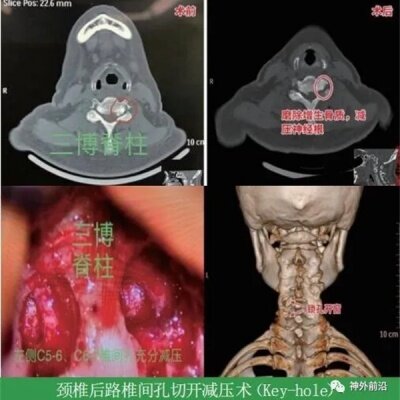 徕卡神刀博览第109期｜专访三博脑科梁聪：个体化治疗退变性脊柱疾病