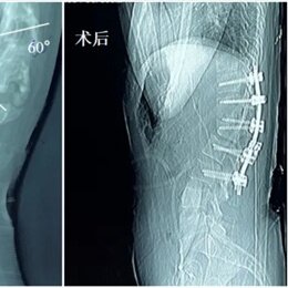 徕卡神刀博览第113期｜三博脑科医院张东骜：肿瘤合并脊柱畸形患者如何选择术式和保护术后神经功能