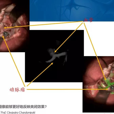 徕卡神刀博览第19期|新型增强荧光在脑血管手术中能做什么 半年临床应用体会