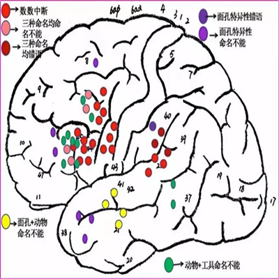 徕卡神刀博览第27期|南部战区总医院王伟民: 2018版唤醒下大脑功能区手术技术指南解读 要关注患者行为学变化 不能仅依靠电生理