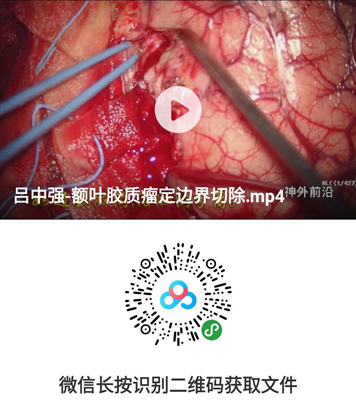 徕卡神刀博览第32期|河北医大二院吕中强：额叶胶质瘤“定边界切除技术”手术视频与操作要点