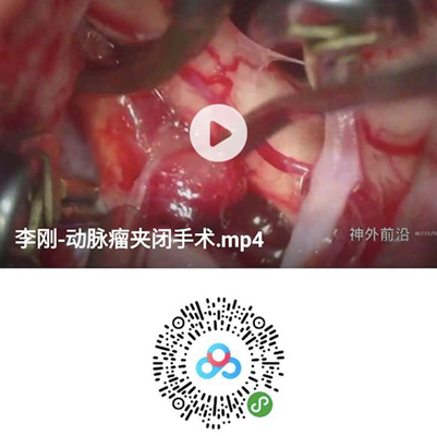 徕卡神刀博览第35期|专访齐鲁医院李刚：缺血性脑血管病和未破裂脑动脉瘤是神外发展新方向 但潜在的手术风险不容忽视