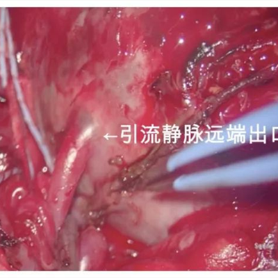 徕卡神刀博览第46期|广州妇儿中心李方成:婴幼儿脑出血应进行DSA等检查 以减少漏诊漏治 附手术视频