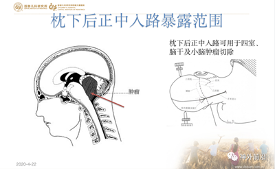 徕卡神刀博览第57期|北京儿研所张冰克：儿童颅内肿瘤的解剖基础与手术入路 | 今晚18点