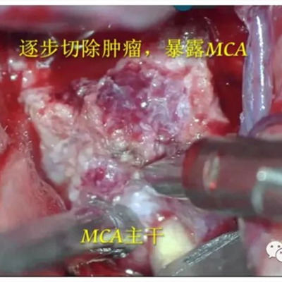 徕卡神刀博览第64期|哈医大肿瘤医院梁鹏：经眶颧入路前床突巨大脑膜瘤切除一例 - 手术视频及讲解