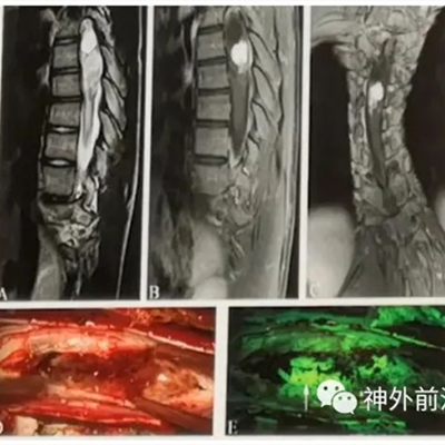 徕卡神刀博览第81期| 王贵怀：清华长庚308例脊髓胶质瘤的治疗策略和预后