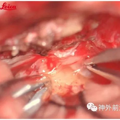 徕卡神刀博览第83期| 南京脑科医院刘宏毅：听神经瘤的膜内切除 如何保护变形为膜状的面神经（手术视频+案例）